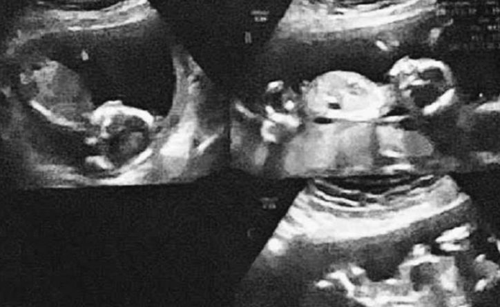„Ich spürte die Mädchen nicht mehr sich bewegen. „Wir können 3 Herzschläge nicht finden.“ Ich musste stark für meine Überlebende bleiben:“ Teenager-Mutter bringt gegen alle Wahrscheinlichkeit frühzeitige Vierlings-„Kämpfer“ zur Welt