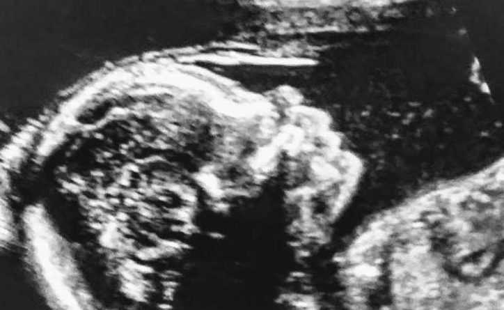 „Ich spürte die Mädchen nicht mehr sich bewegen. „Wir können 3 Herzschläge nicht finden.“ Ich musste stark für meine Überlebende bleiben:“ Teenager-Mutter bringt gegen alle Wahrscheinlichkeit frühzeitige Vierlings-„Kämpfer“ zur Welt